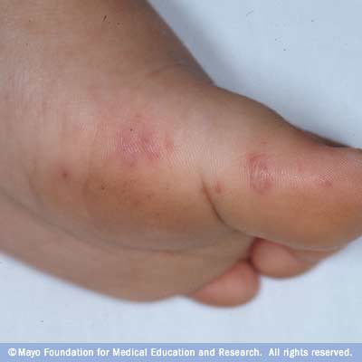 Blisters on hands and feet - Small itchy water blisters ...