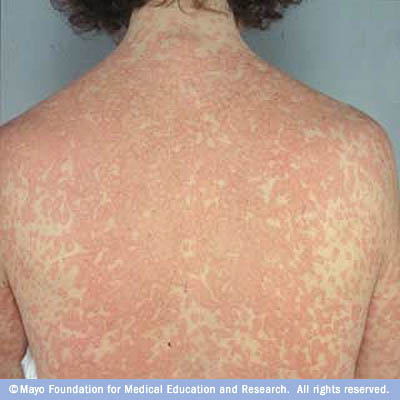 Rash | Dermatitis | Skin Rash | MedlinePlus