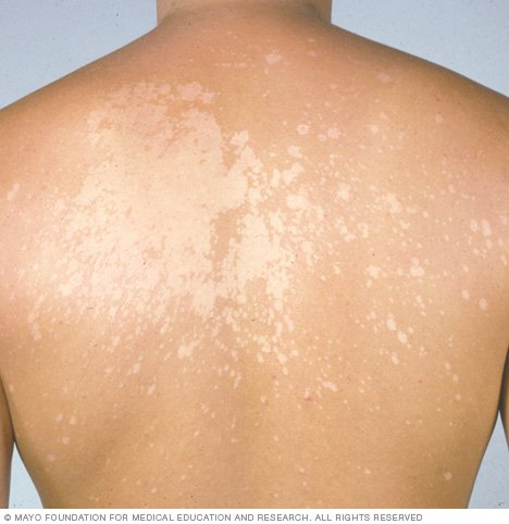 Tinea versicolor Disease Reference Guide - Drugs.com
