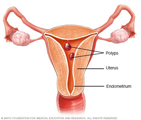 What can you expect from your menstrual cycle after uterine polyp removal?