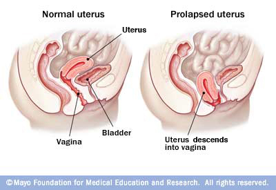 women guide vaginal prolapse women guide vaginal prolapse