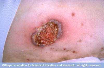 open sore on pyoderma gangrenosum disease reference guide drugs open sore on pyoderma gangrenosum disease reference guide drugs