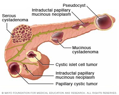 Image result for cystadenoma pancreas causes, symptoms & treatments