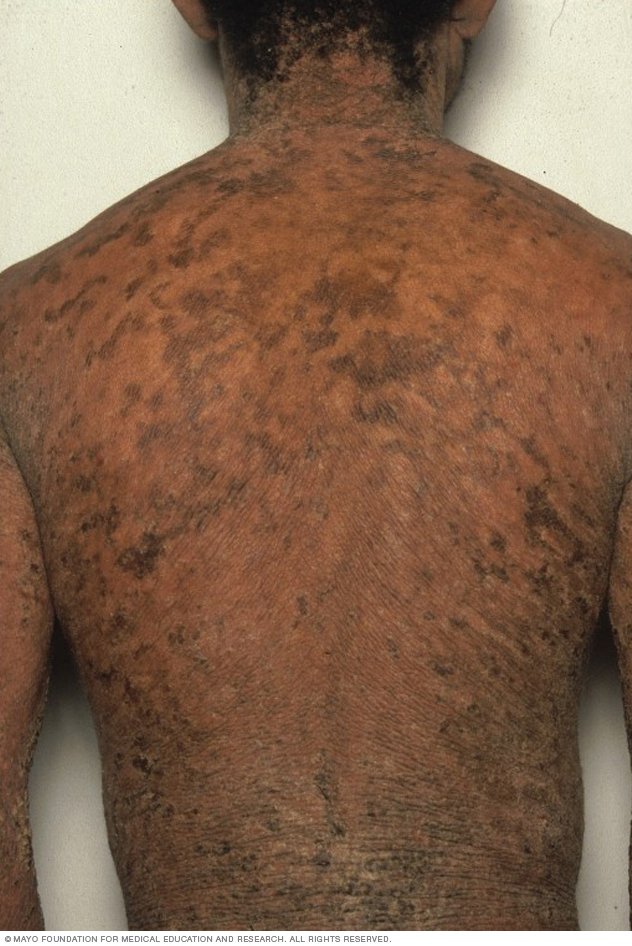 Ichthyosis vulgaris behandelen met Dode Zee mineralen en ...