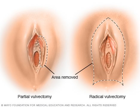 Lichen Sclerosus - British Skin Foundation