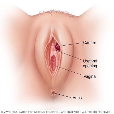 Vaginal tears - Women's Health - MedHelp