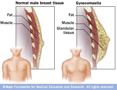 Steroids male breast growth