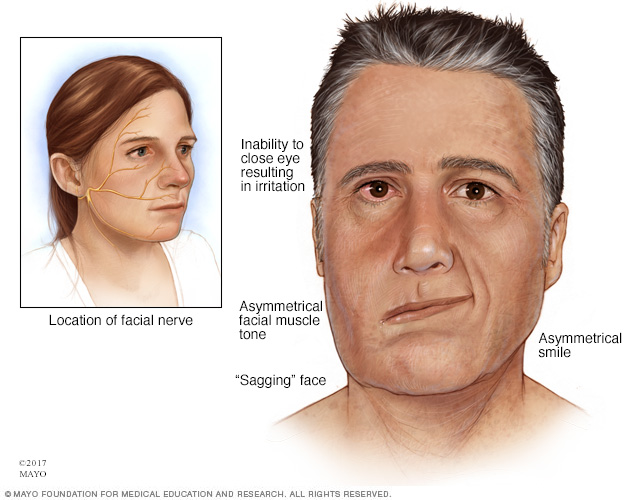 Facial Muscle Weakness 38