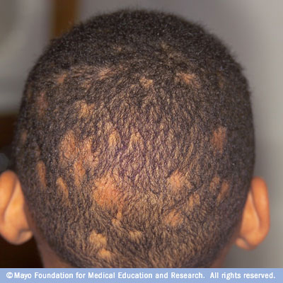 Scalp Conditions: 28 Causes, Photos, & Treatments