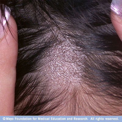 Ringworm of the Scalp (Tinea Capitis) - Healthline