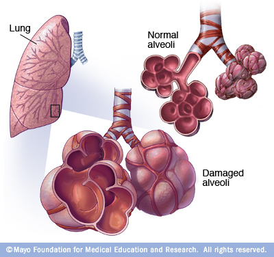 Can A Dog Have Copd And Asthma Can A Dog Have Copd And Asthma