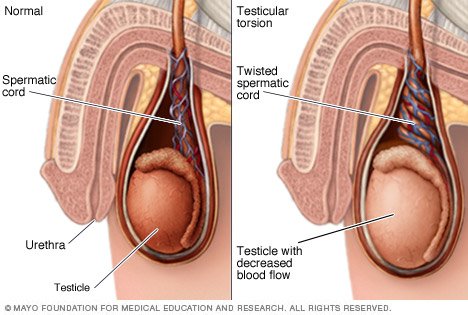 Penis Torsion 18