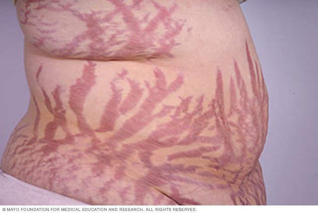 Stretch Marks Disease Reference Guide