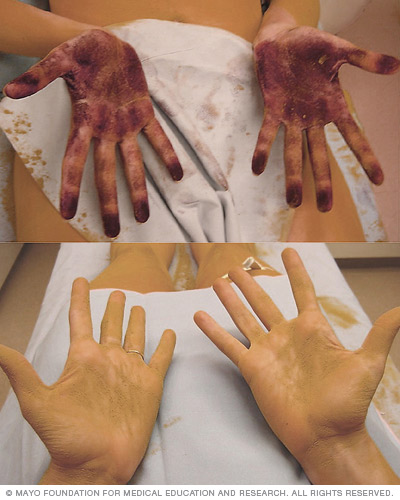 types of hyperhidrosis