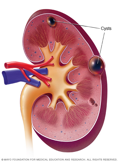Kidney Cysts Disease Reference Guide Drugs image-result-for-bosniak-radiolog-a-diagnostico-por-imagenes-anatom-a