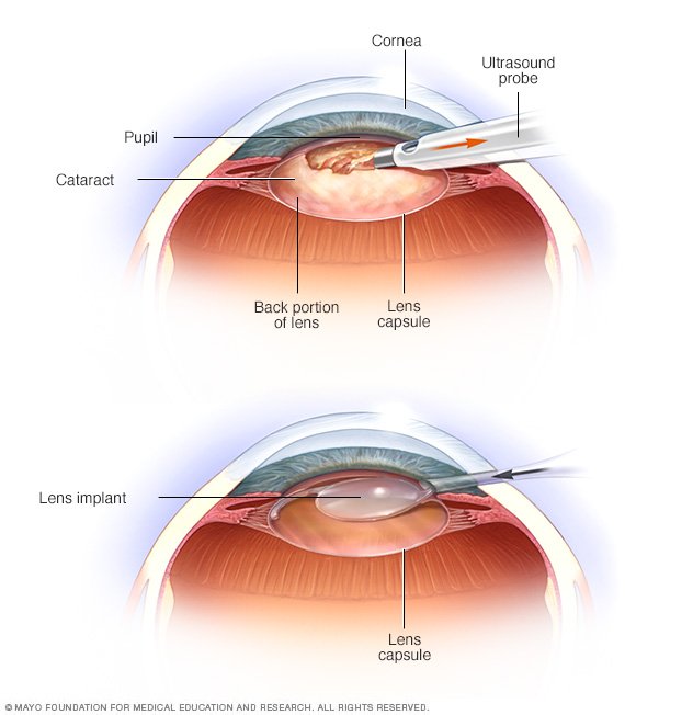 cataract surgery cataracts disease reference guide drugs cataract surgery cataracts disease reference guide drugs