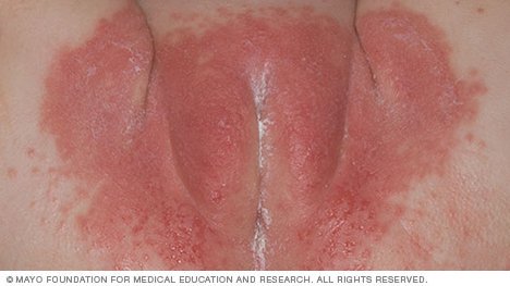 rashes caused by antibiotics