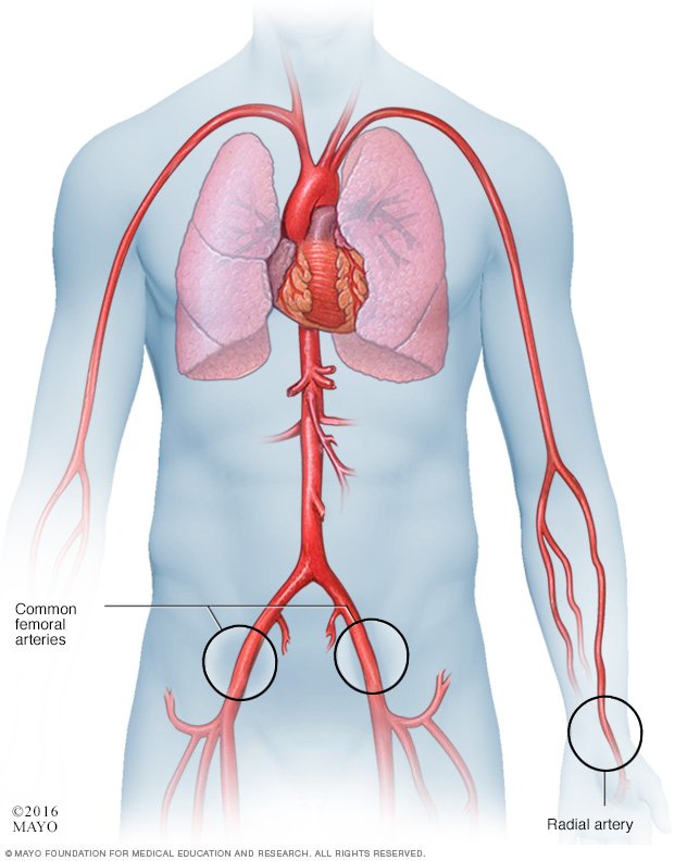 Spontaneous coronary artery dissection (SCAD) Disease ...