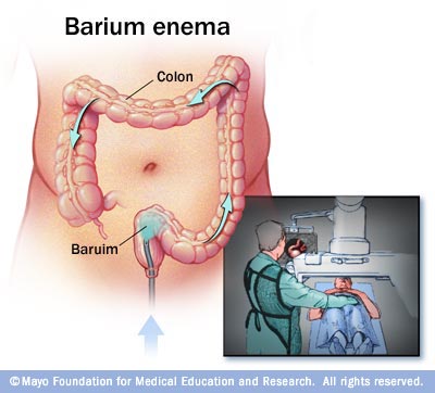 Barium Enema X Ray Versus Colonoscopy Diet