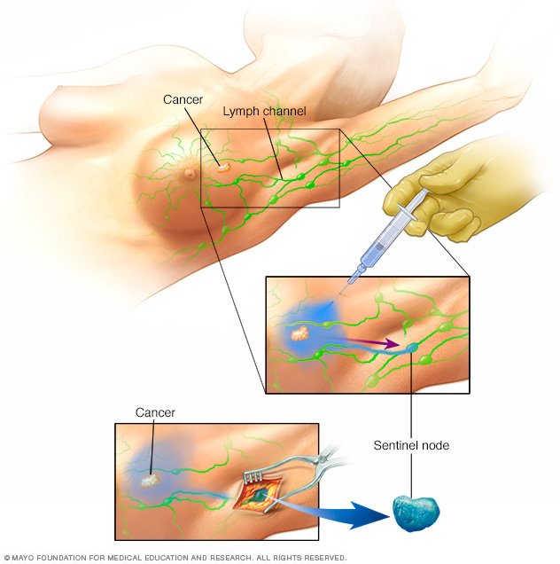 Natural Treatment For Lymph Node Cancer Natural Treatment For Lymph Node Cancer