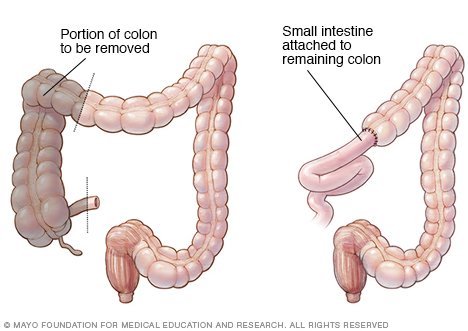 Pregnancy after colectomy