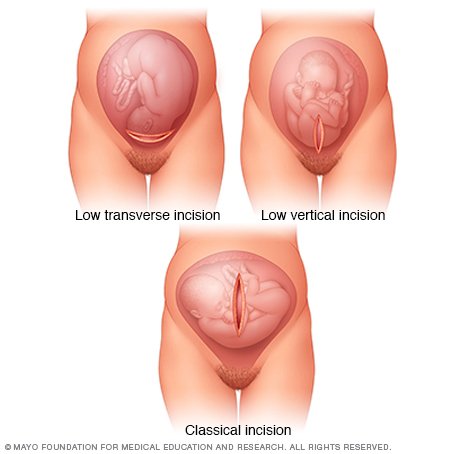 C Sec Vs Natural Birth C Sec Vs Natural Birth