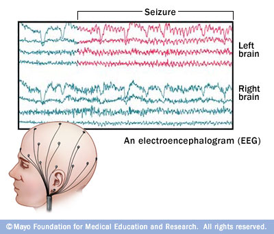 EEG (electroencephalogram) - Drugs.com