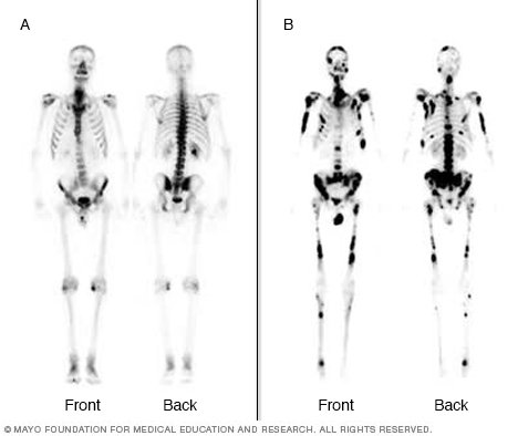 what does bone density mean what does bone density mean