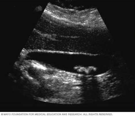 ultrasound