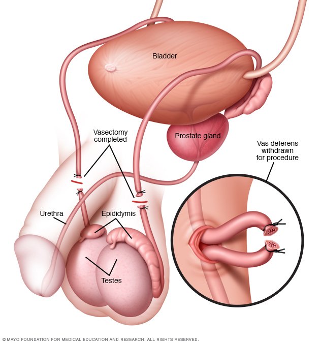 brunette beach strip build up of sperm after vasectomy