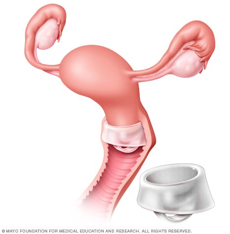 sex before antibiotics started birth control sex before antibiotics started birth control