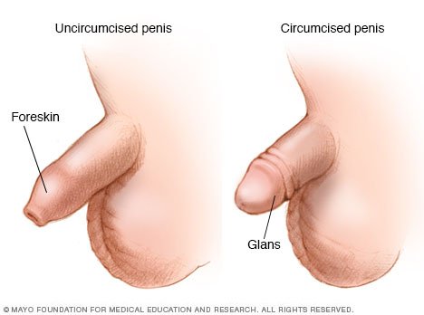 Circumcision Of Penis 69