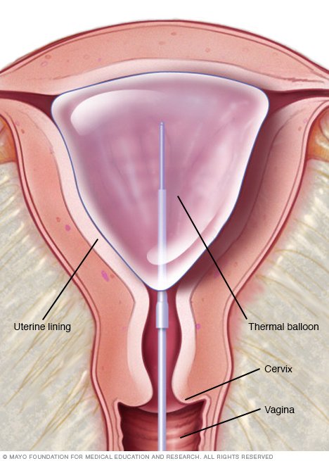 Thermal Balloon Ablation 96