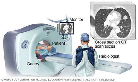 ct scan slices scans slice drugs lung heart body cross mayo clinic patient allow doctors sectional shows