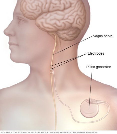 Vagus nerve stimulation - Drugs.com
