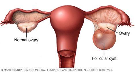 After Clomid Continuing Ovulate Stopping