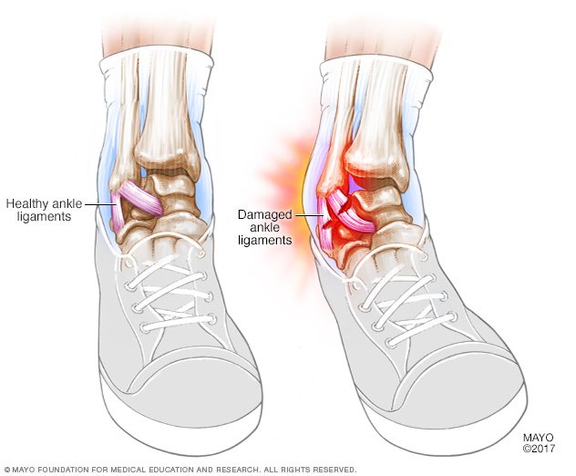 Sprained ankle Disease Reference Guide