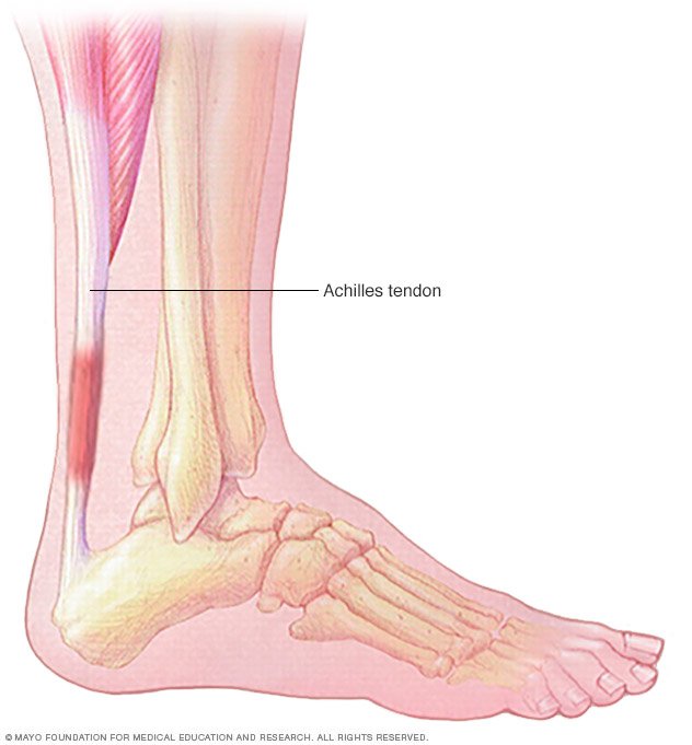 What Is the Achilles Tendon