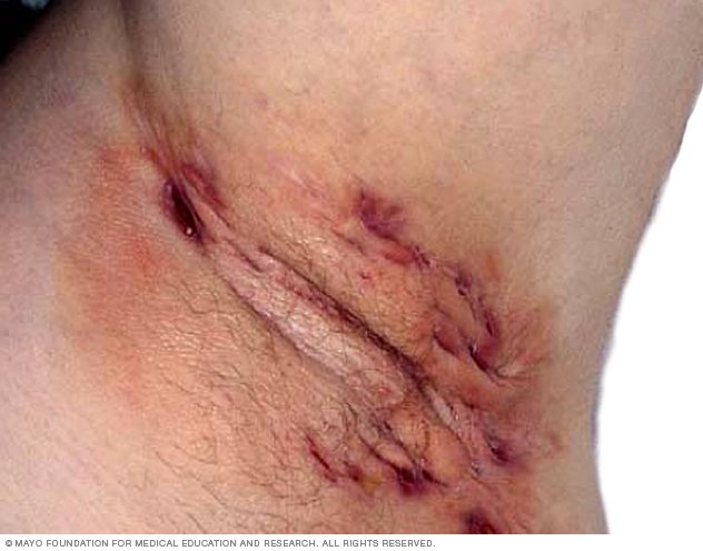 grammy sex videos hidradenitis suppurativa vulva