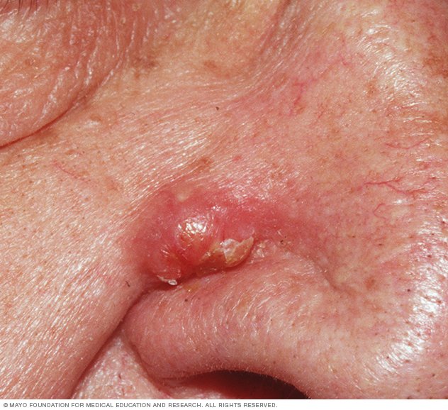 Cum with wife Facial cyst and rheumatoid arthritis