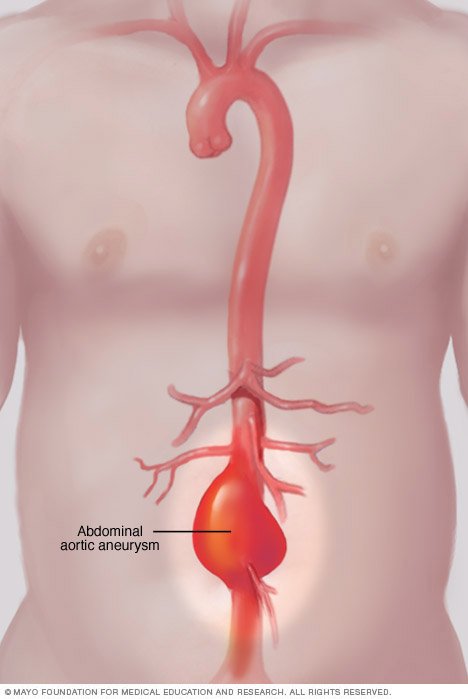 Abdominal aortic aneurysm Disease Reference Guide Drugs.com Abdominal aortic aneurysm Disease Reference Guide Drugs.com