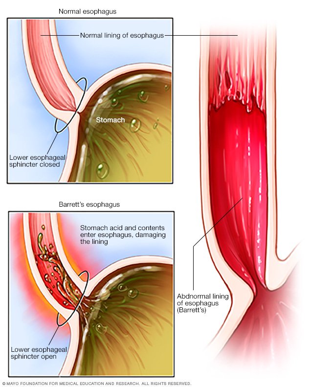 Barrett's esophagus Disease Reference Guide - Drugs.com