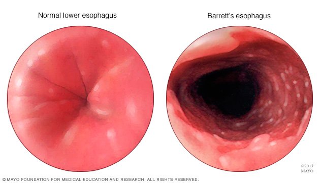 Barrett's esophagus Disease Reference Guide - Drugs.com
