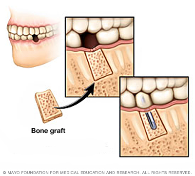 Dental Implants