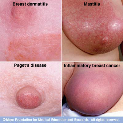 Apologise, Symptom of breast disease assured, what Symptom of breast disease thanks