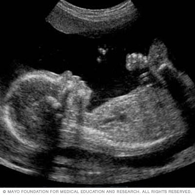 ultrasound
