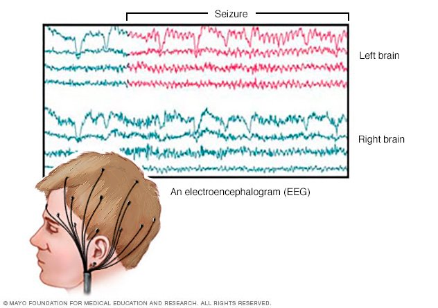 Epilepsy Disease Reference Guide - Drugs.com