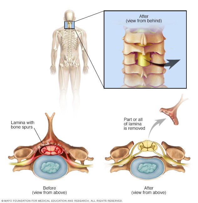 Spinal stenosis Disease Reference Guide Drugs com Spinal stenosis Disease Reference Guide Drugs com
