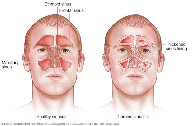 Deviated septum nasal polyps dislodged broken nose before and after 