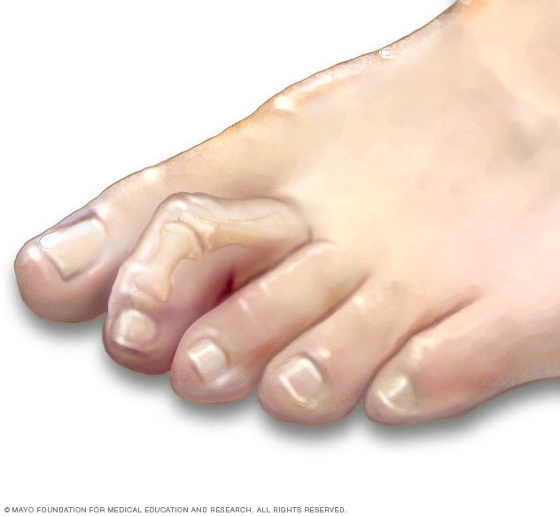 Bump On Pinky Toe From Shoes Bump On Pinky Toe From Shoes